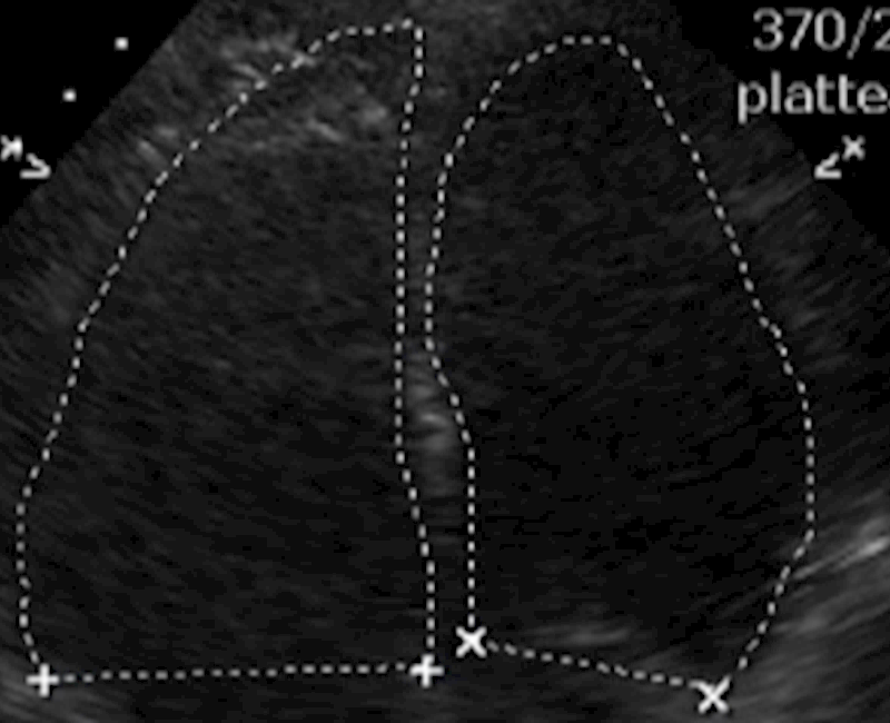 Diagnosis of fat embolism syndrome using point-of-care ultrasound